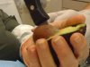 La peligrosa “mano de aguacate” aumenta entre jóvenes en Alemania