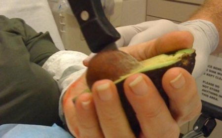 La peligrosa “mano de aguacate” aumenta entre jóvenes en Alemania