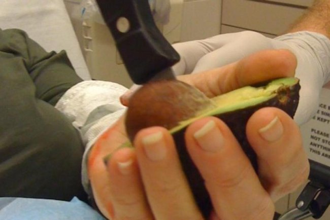 La peligrosa “mano de aguacate” aumenta entre jóvenes en Alemania