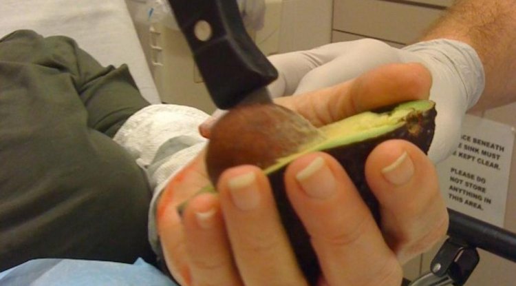 La peligrosa “mano de aguacate” aumenta entre jóvenes en Alemania