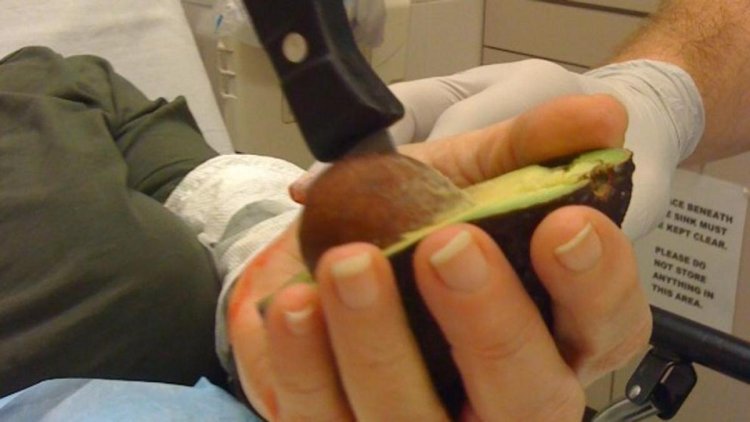 La peligrosa “mano de aguacate” aumenta entre jóvenes en Alemania